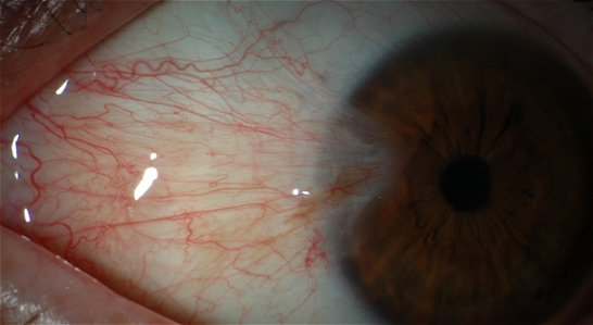 pterygium